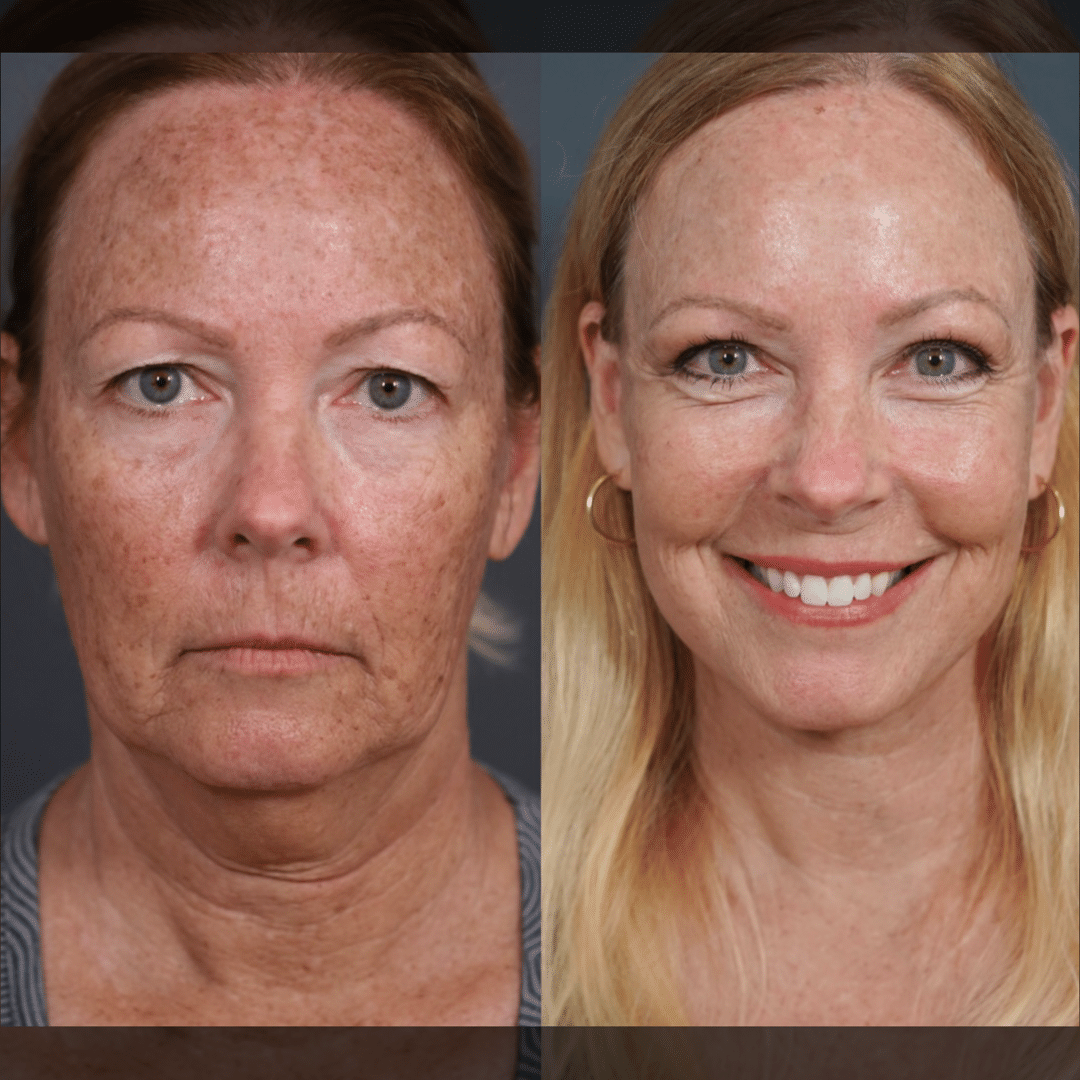 BBL HERO™ Skin Rejuvenation 4 image 13