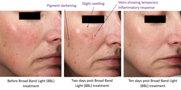 BBL HERO™ Skin Rejuvenation 6 image 14