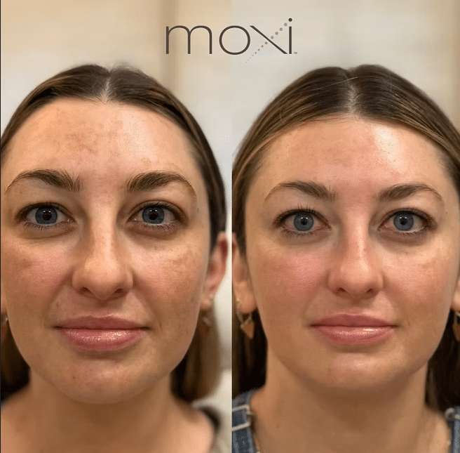 MOXI® Laser Skin Rejuvenation 3 image 19