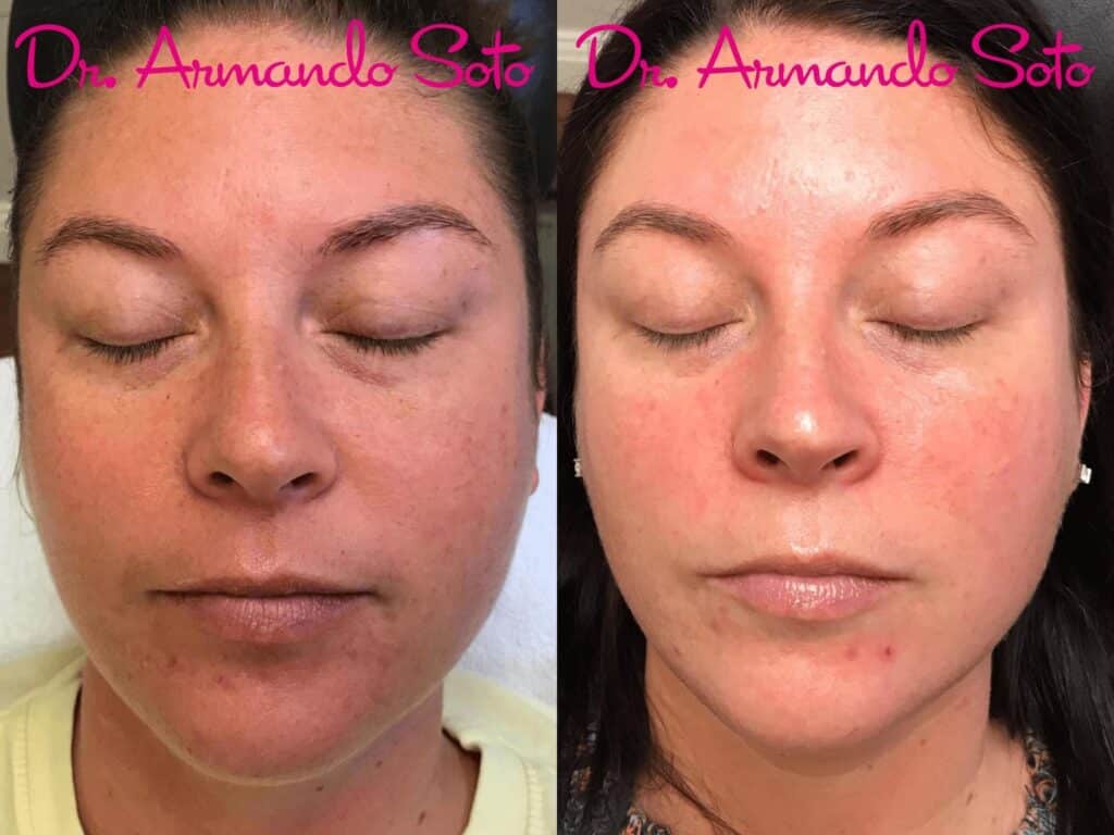 BBL HERO™ Skin Rejuvenation 1 image 26