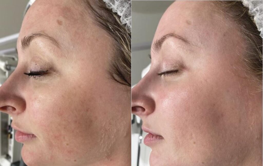 BBL HERO™ Skin Rejuvenation 2 image 27