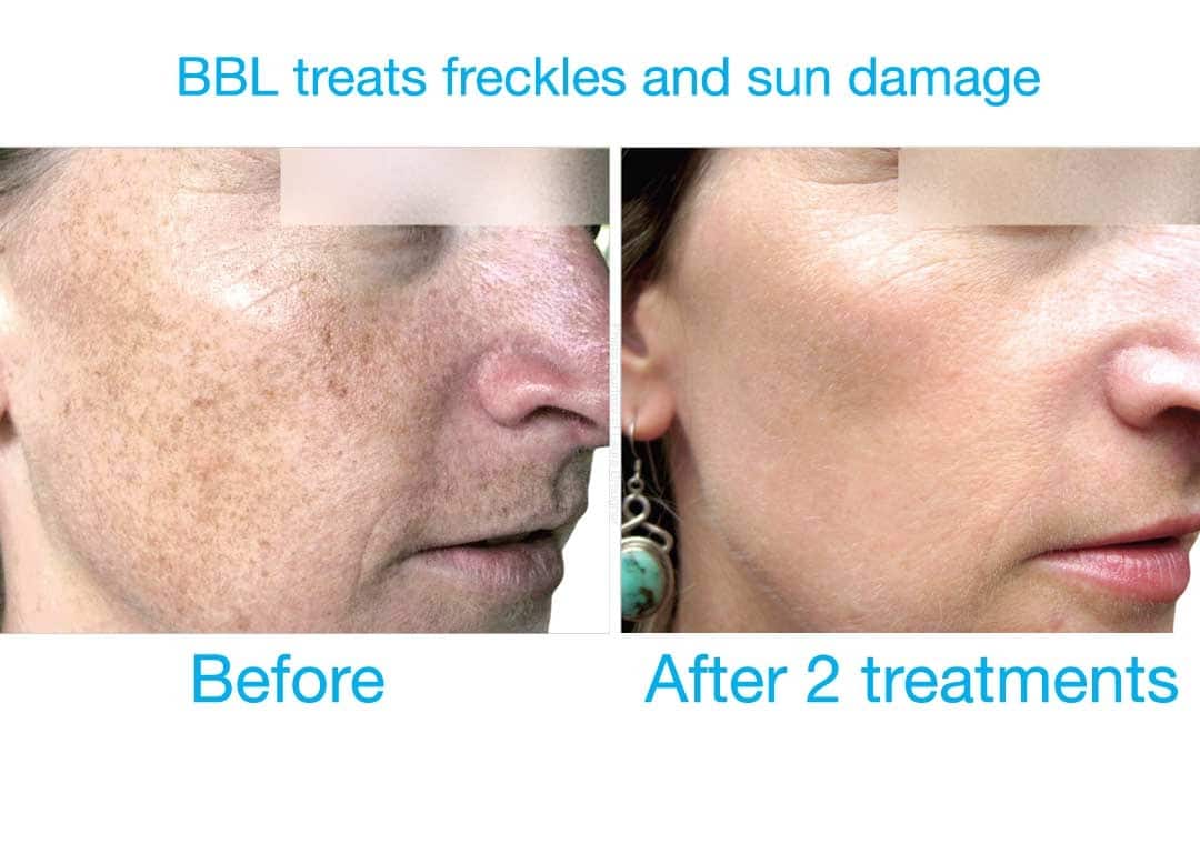 BBL HERO™ Skin Rejuvenation 3 image 30