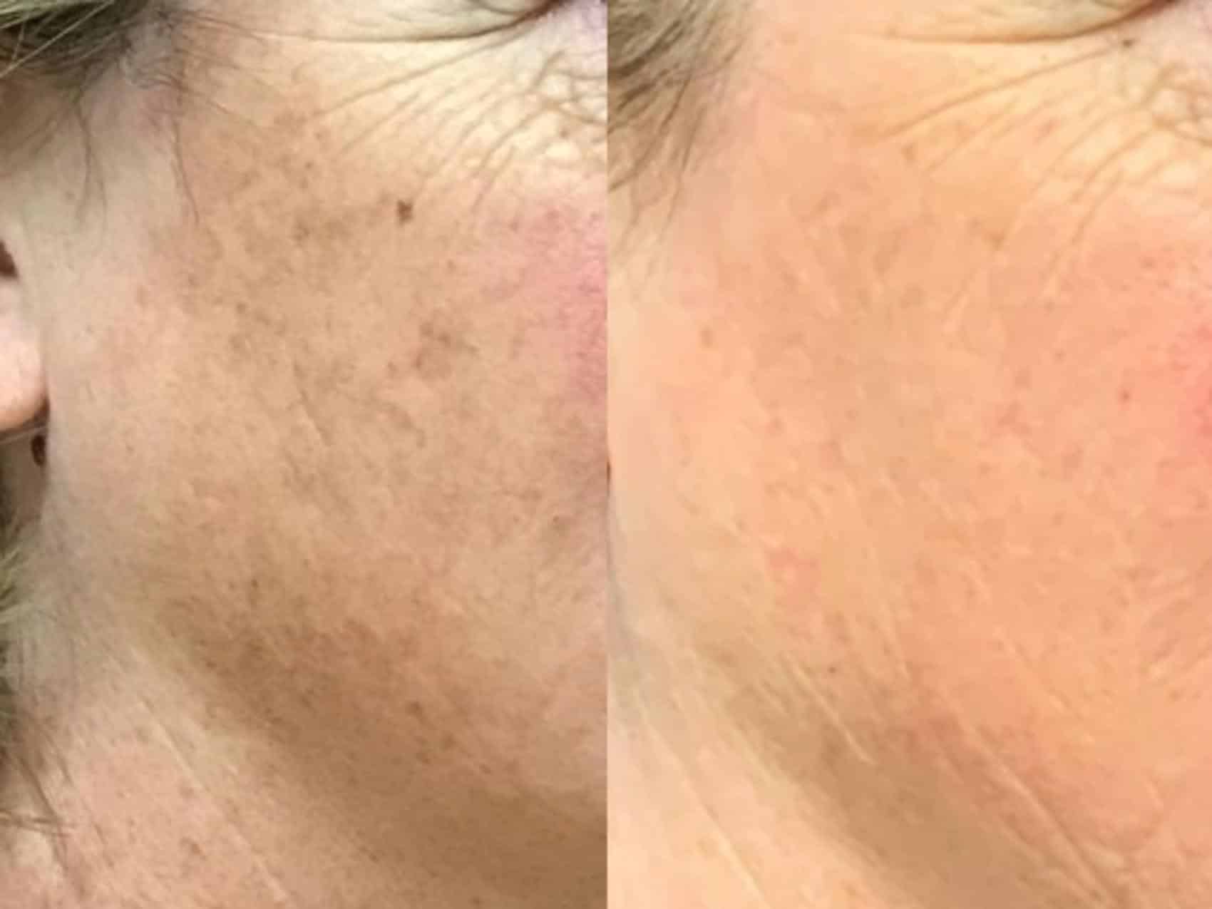 BBL HERO™ Skin Rejuvenation 5 image 32