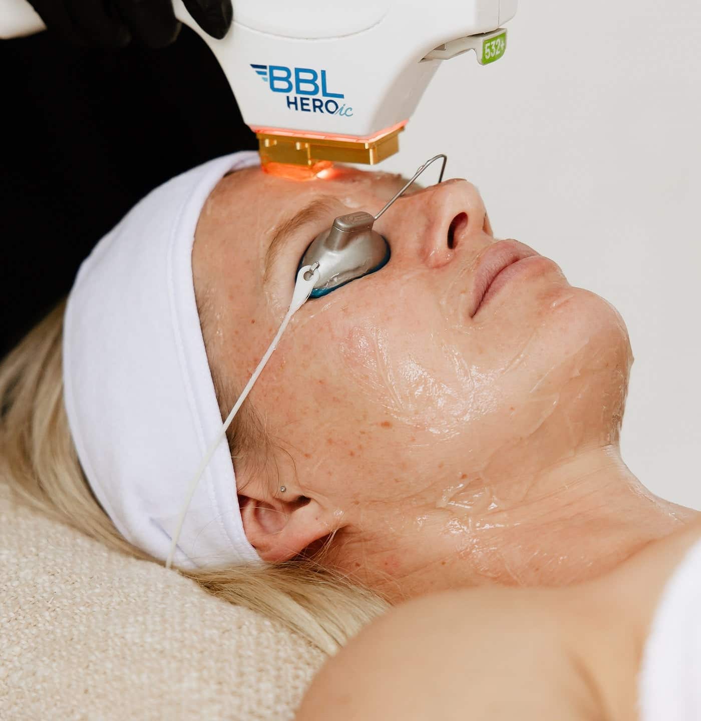 BBL HERO™ Skin Rejuvenation 8 image 34