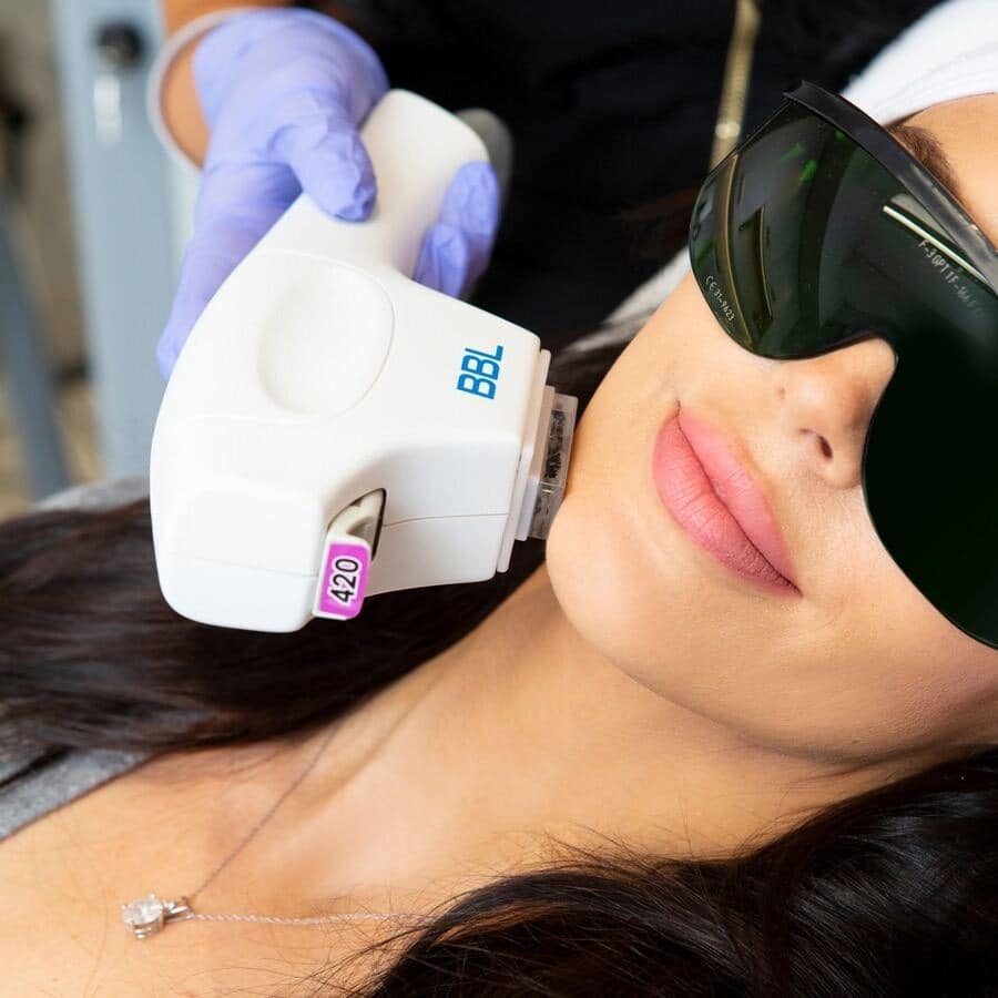 BBL HERO™ Skin Rejuvenation 9 image 35