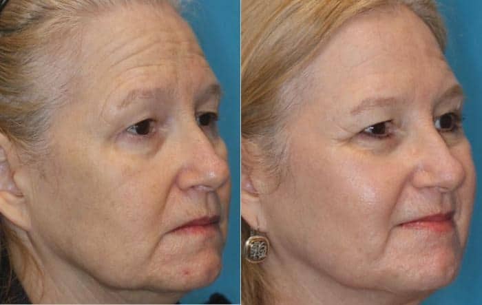 BBL HERO™ Skin Rejuvenation 10 image 37