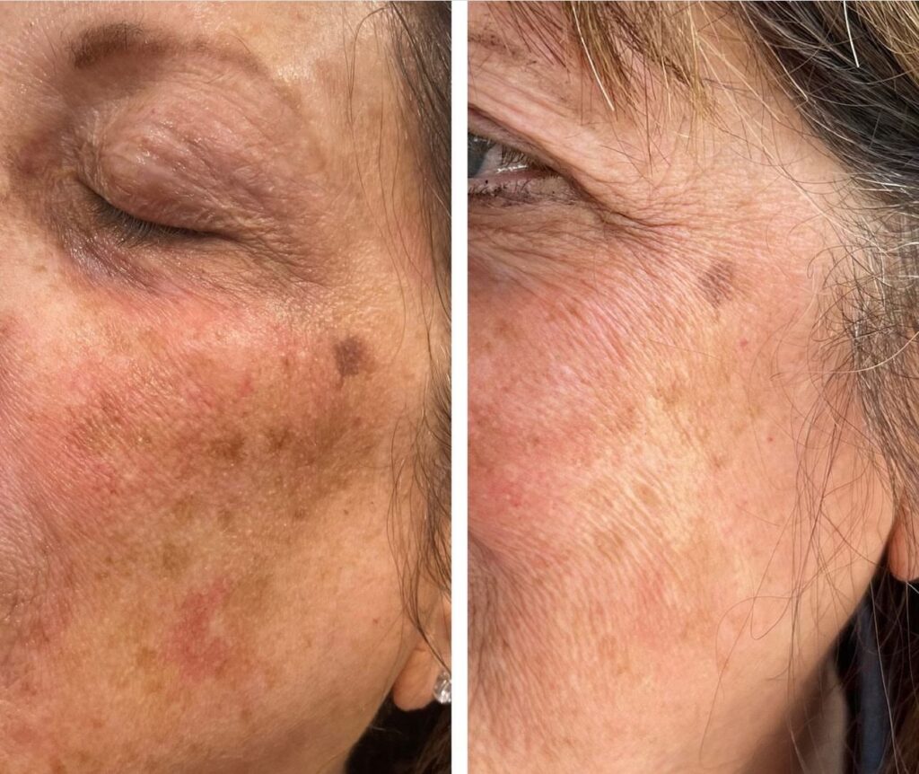 MOXI® Laser Skin Rejuvenation 2 image 54